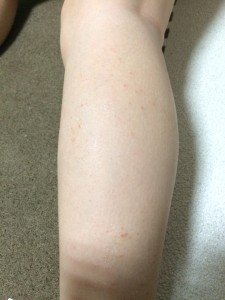足の湿疹